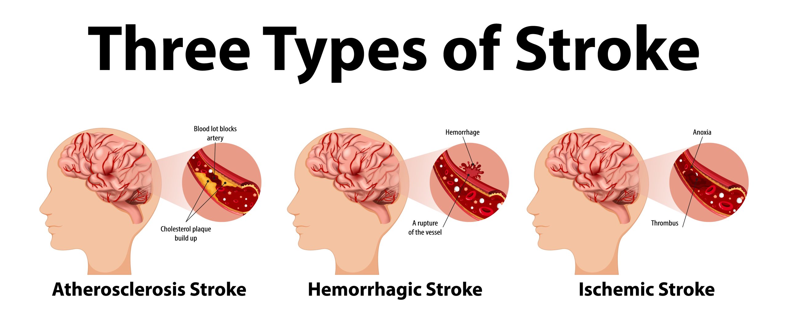 Types of strokes